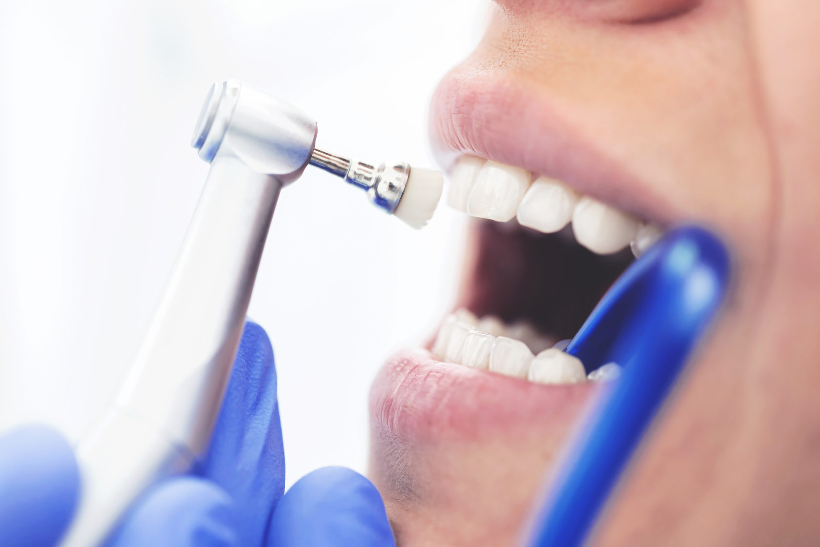 чистка зубов в стоматологии